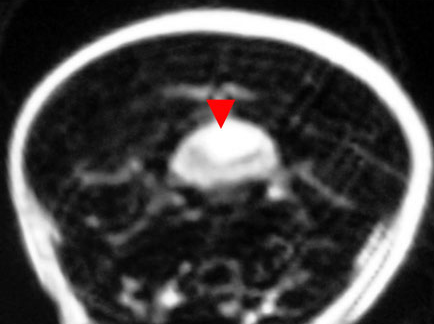 Скопление жидкости в области 2-4 сегментов спинного мозга в шейном отделе