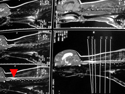 На серии снимков МРТ можно увидеть скопление жидкости в области 2-4 сегментов спинного мозга в шейном отделе