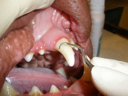 Правильное наддесневое расположение кюреты относительно поверхности зуба
