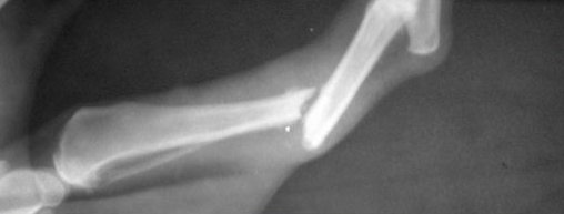 Рентгеновский снимок в боковой проекции. Образовался ложный сустав