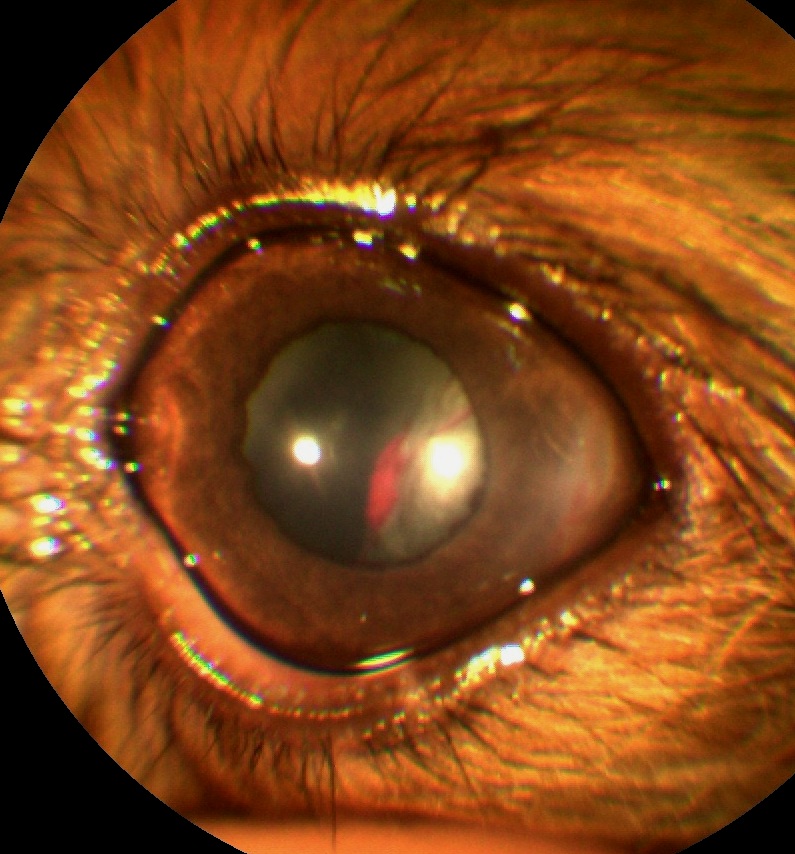 Рисунок 2. Травматическая катаракта